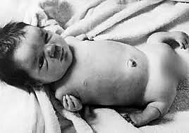 baby-birth-defects-thalidomide
