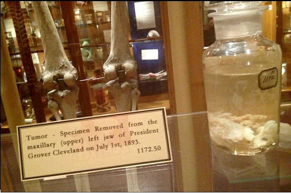 President Cleveland’s Jaw Tumor at Mutter Museum